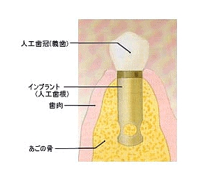 インプラント インプラント